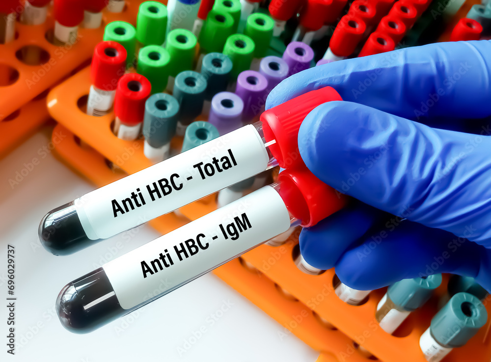 Wall mural Hepatitis Core antibody (Anti HBC Total and Anti HBC IgM) test.