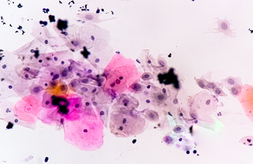 Photomicrograph of Paps smear: Inflammatory smear with HPV related changes. Cervical cancer. SCC