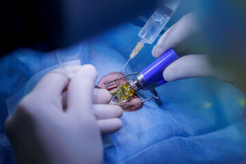 Doctor use equipment for corneal flap formation, patient under sterile cover. Process laser vision...