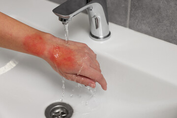 Woman holding burned hand under cold water indoors, closeup