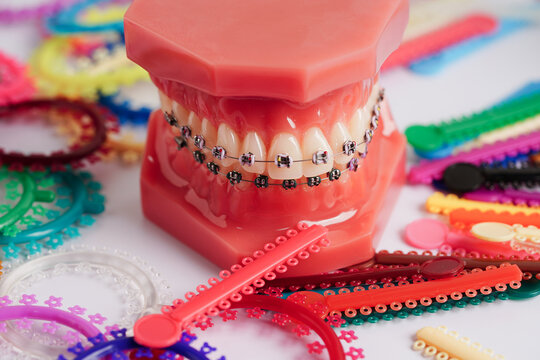 390+ Braces Rubber Bands Stock Photos, Pictures & Royalty-Free