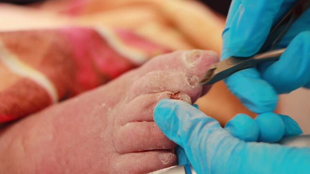 A podiatrist makes a pedicure to an old woman with sore nails with a special tool. Fungus and stratification of nails. Close-up