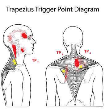 Trapezius Trigger Point Diagram Vector