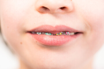 Naklejka premium Little girl with rainbow braces