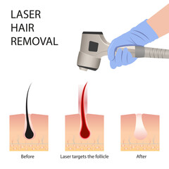 Laser hair removal of the skin layer and follicle for beauty and smoothness of the body. Hair removal procedure
