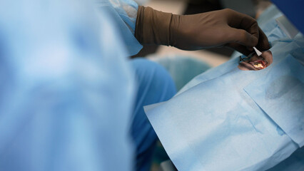 Surgeon's hands in gloves performing laser vision correction, eye surgery. Vision correction...