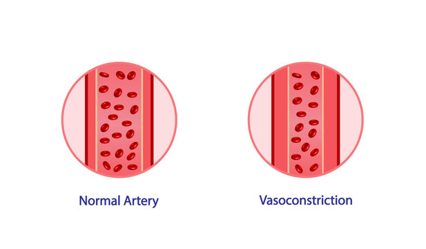 Arterial vasoconstriction. Cross section of arteries. Comparison of normal and constricted blood vessels. Scientific Diagram. Vector illustration.