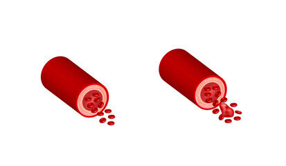 Thromboembolism. Circulating blood clot. Normal blood flow and a thrombus in blood flow, embolus. Red blood cell. Vector illustration.