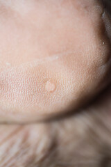 Fototapeta premium The skin of a person's feet has the appearance of wounds, corns, calluses, and blemishes.