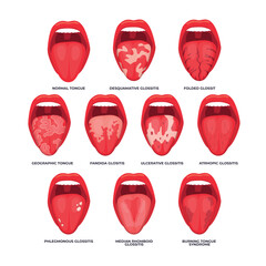 Set of different types of glossitis collection, Diagram of tongue disease in different stages for infographic biology education school, Candidiasis of the tongue, thrush. Inflammation of the tongue. - obrazy, fototapety, plakaty