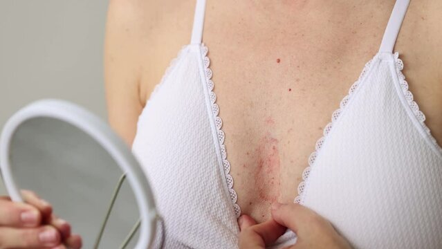 4K A woman with red eczema on her chest looking in the mirror. Skin diseases. 