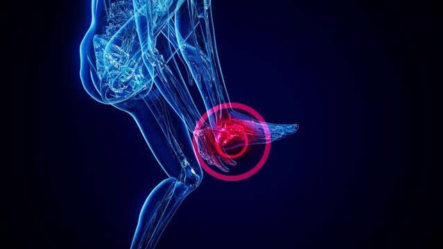 4K abstract animation of plantar fascitis