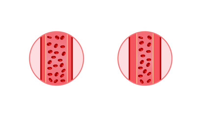 Arterial vasoconstriction. Cross section of arteries. Comparison of normal and constricted blood vessels. Scientific Diagram. Vector illustration.