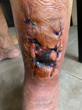 Pasca debridement treatment of infected wound of diabetes foot medical with inflammation effect and sewing wounds, blood tissue healing skin