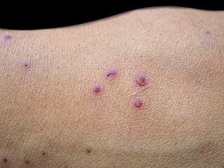Itching skin lesions with scabs on the hand