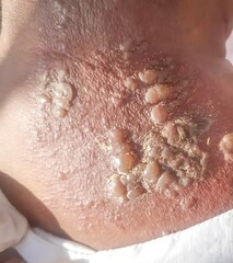 Herpes simplex infection at nape. Small and painful vesicles. - obrazy, fototapety, plakaty
