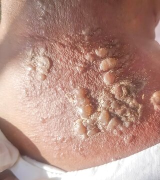 Herpes simplex infection at nape. Small and painful vesicles.