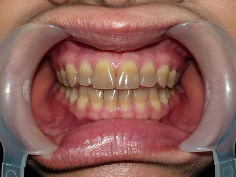 Closeup of teeth with tetracycline staining.