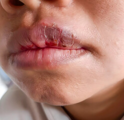 Dry, cracked and dehydrated lip of Asian patient.