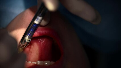 Beautiful Woman in dentist chair at appointment with dental surgeon during wisdom tooth removal and dental care process. 4k 120 fps slow motion cinematic footage