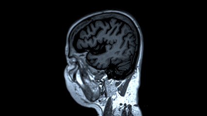 MRI brain scans sagittal view offer valuable insights into brain