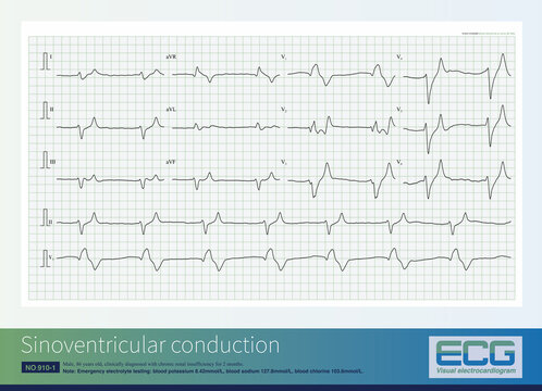 When the blood potassium concentration significantly increases, it can inhibit ventricular conduction, cause diffuse intraventricular block, and generate wide QRS waves and sinoventricular conduction.