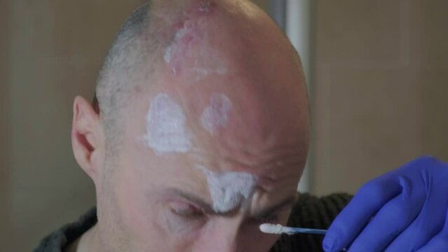 Man with painful shingles virus. Scabs and blisters on his face, head and above his eye. Reflection in bathroom mirror. Treating with calamine lotion.