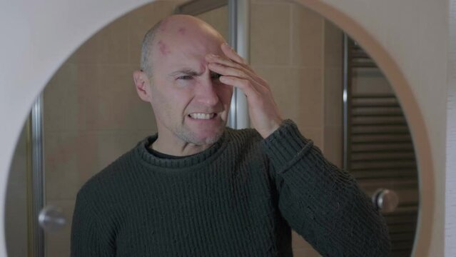 Man with painful shingles virus. Scabs and blisters on his face, head and above his eye. Reflection in bathroom mirror.