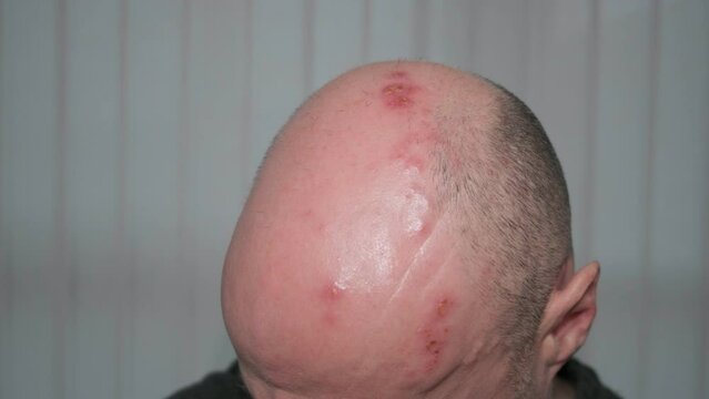 Man with painful shingles virus. Scabs and blisters on his face, head and above his eye. 