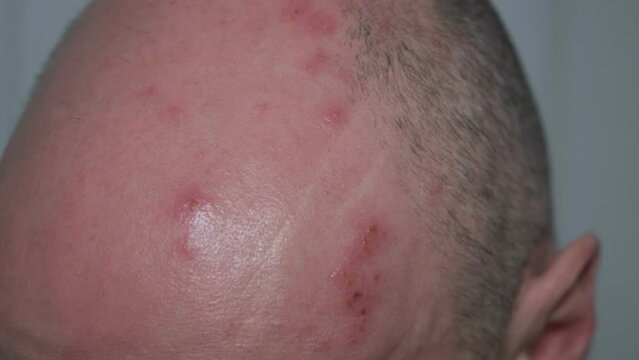 CU Man with painful shingles virus. Scabs and blisters on his face and head.