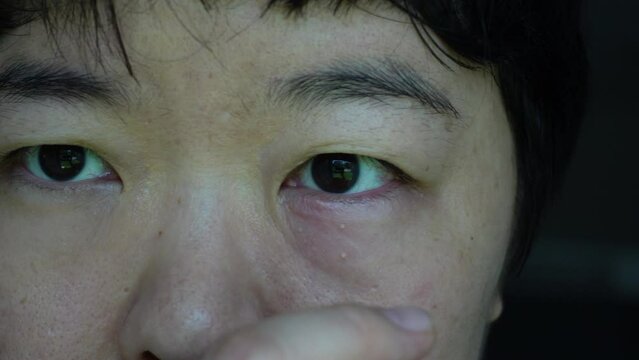 Asian woman eye itch blinking with stye and red eye infected