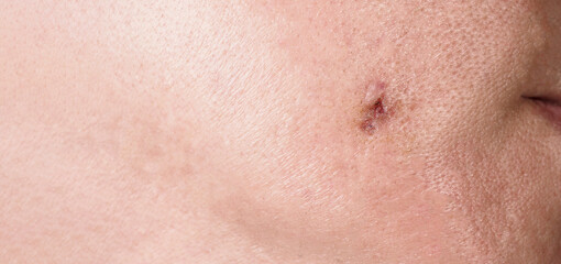 Scars from facial abscess or big acne surgery.  Scars from inflammation of the skin after medical...