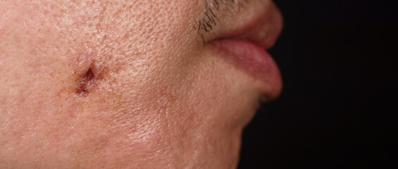 Scars from facial abscess or big acne surgery.  Scars from inflammation of the skin after medical...