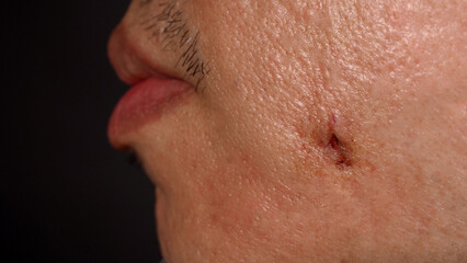 Scars from facial abscess or big acne surgery.  Scars from inflammation of the skin after medical...