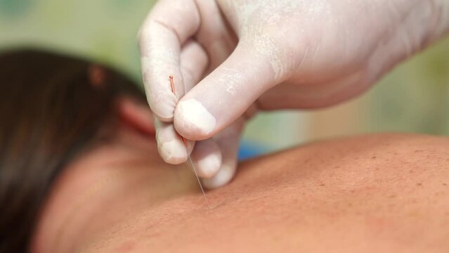 Doctor puts needles into female back on the acupuncture treatment therapy in spa salon. Alternative Medicine concept.  Close up acupuncturist applying acupuncture needles to woman's neck

