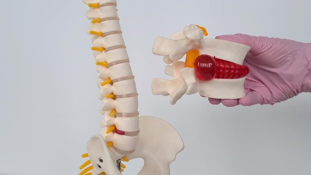 Convex red intervertebral disc herniation on model of spine. Treatment of problems and diseases of spine