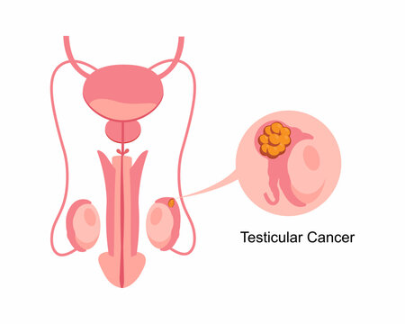 Testicular cancer male reproductive system disease, oncology diagnosis Testis anatomy in human body Man sexual organ