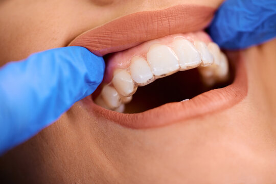 Close up of woman getting dental aligner on her teeth at dentist's.