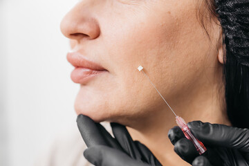 Thread lifting is a cosmetic facial rejuvenation procedure. A cosmetologist implants cosmetic...
