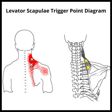 Levator Scapulae Trigger Point Diagram, Trigger Point Diagrams