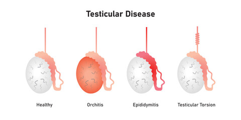 Testicular Disease Types Scientific Design. Vector Illustration. - obrazy, fototapety, plakaty
