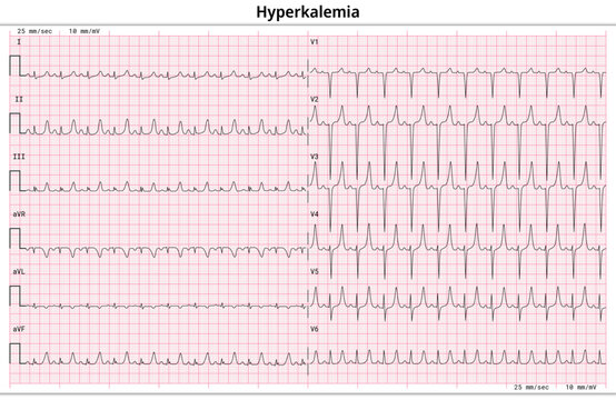 ECG Hyperkalemia - Hyperkalaemia - 12 Lead ECG Common Case - 6 Sec/lead - Vector Medical Illustration