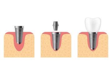 Dental implant. Realistic implant structure, graphic models of the crown. Screw prosthesis, orthodontic dental implantation - obrazy, fototapety, plakaty