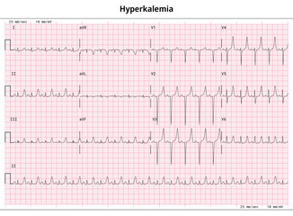 ECG Hyperkalemia - Hyperkalaemia - 12 Lead ECG Common Case - 3 Sec/lead - Vector Medical Illustration