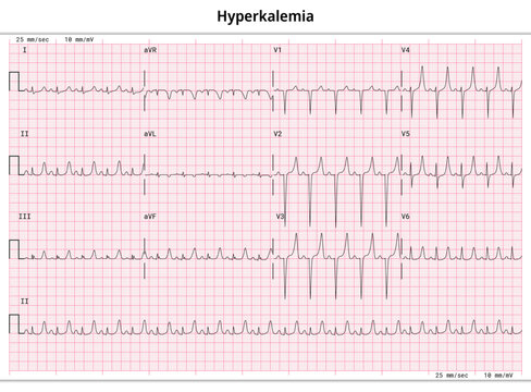 ECG Hyperkalemia - Hyperkalaemia - 12 Lead ECG Common Case - 3 Sec/lead - Vector Medical Illustration