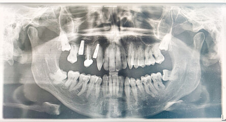 Tooth rx - obrazy, fototapety, plakaty