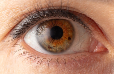 Moles in the retina of the eye. Macro