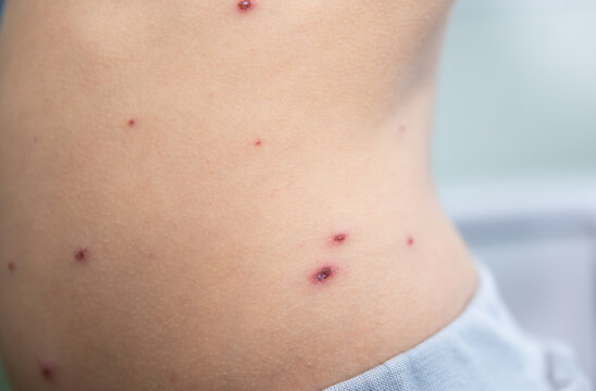 The child has spotted red pimples and a blistering rash from chickenpox or the varicella zoster virus. Viral disease in children. Red pimples all over the body. Infection.

