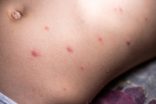 The child has spotted red pimples and a blistering rash from chickenpox or the varicella zoster virus. Viral disease in children. Red pimples all over the body. Infection.
