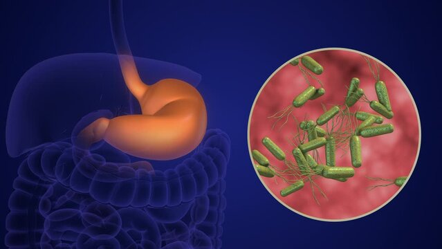 Stomach infection caused by Helicobacter pylori